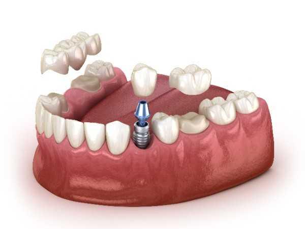 invisalign Leeds